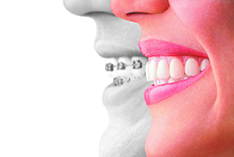 Can I Vape or Smoke With Clear Aligners? - Fergus Orthodontics