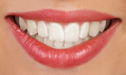 Why You Should Consider Clear Braces - Frankford Dental Care